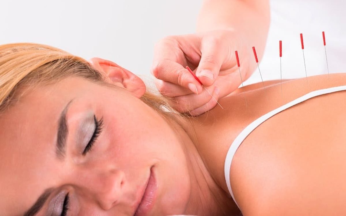 Acupuntura en Peñalolén realizada por kinesióloga acupunturista certificada